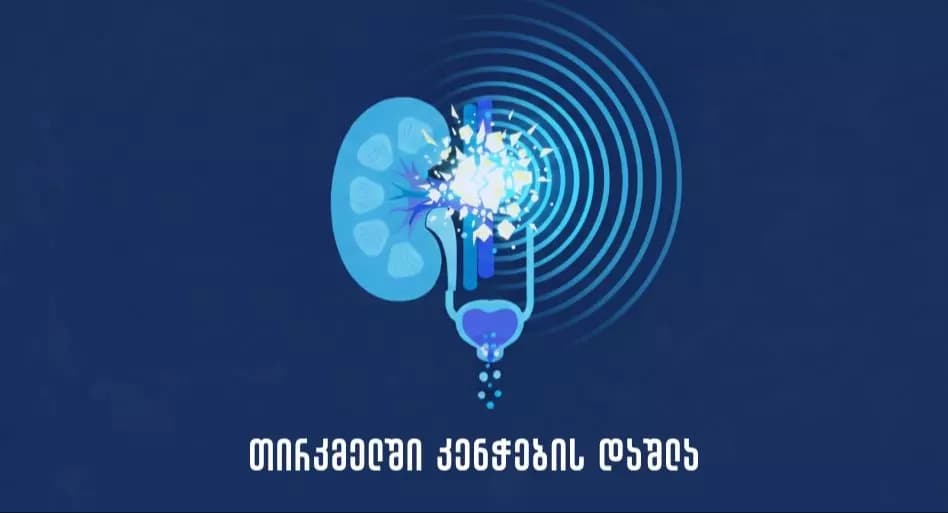 თირკმლის კენჭების დაშლა ბოჭორიშვილის კლინიკაში
