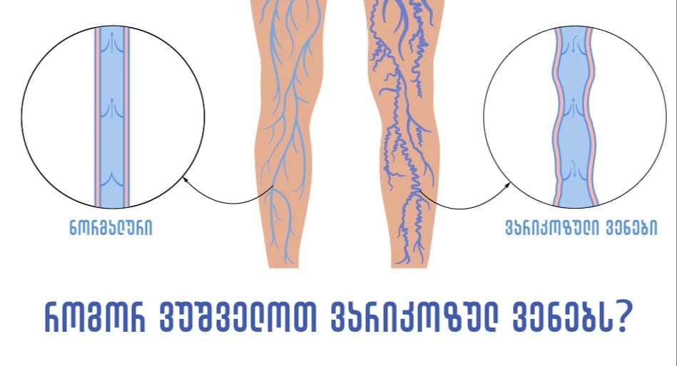 Dopplerography-of-blood-vessels