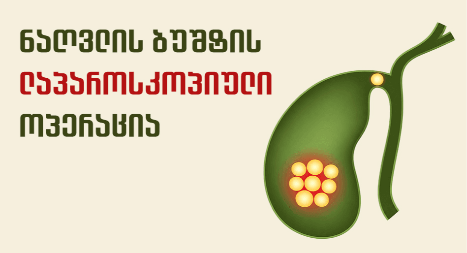 Лапароскопическая-хирургия-желчного-пузыря