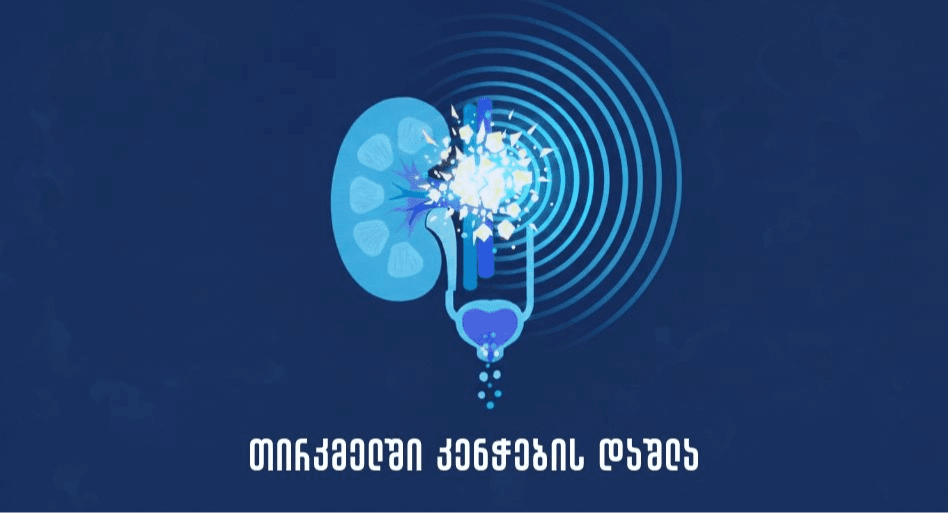 თირკმლის კენჭების დაშლა ბოჭორიშვილის კლინიკაში