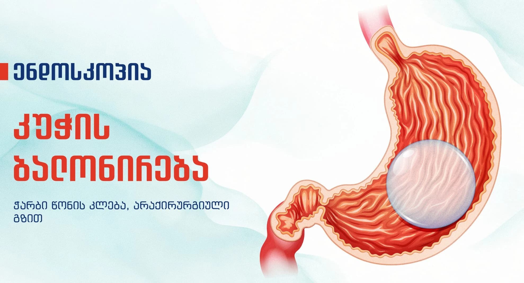 Gastric Ballooning: Candidates, Results, and Risks