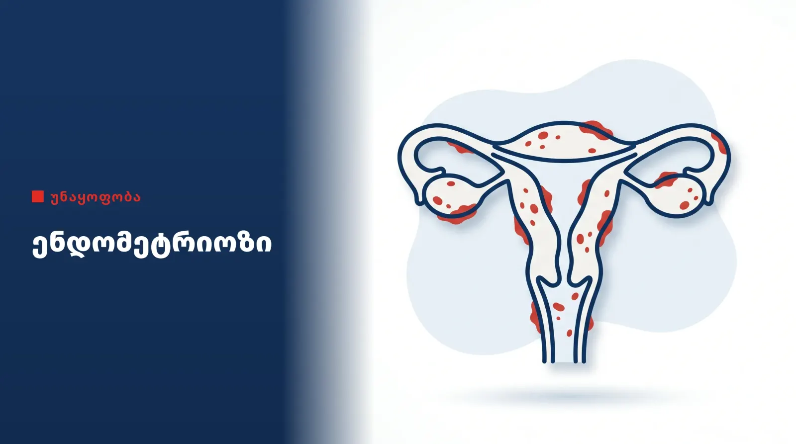 endometriosis