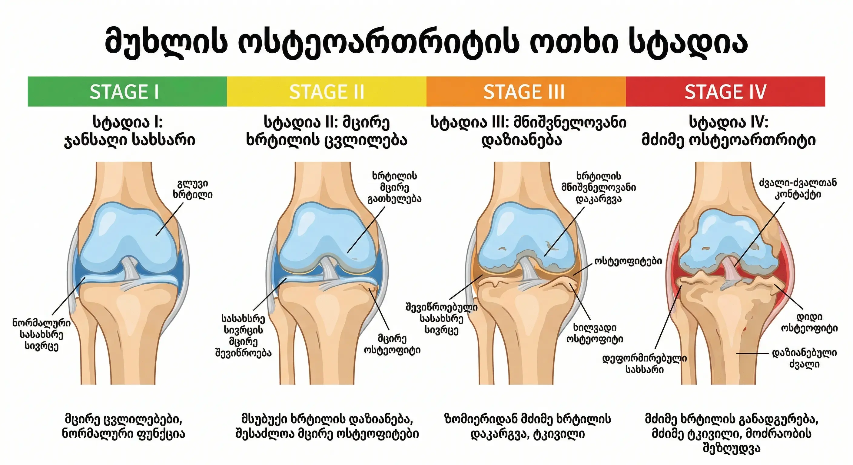 muxlis-osteoartritis-otxi-stadia