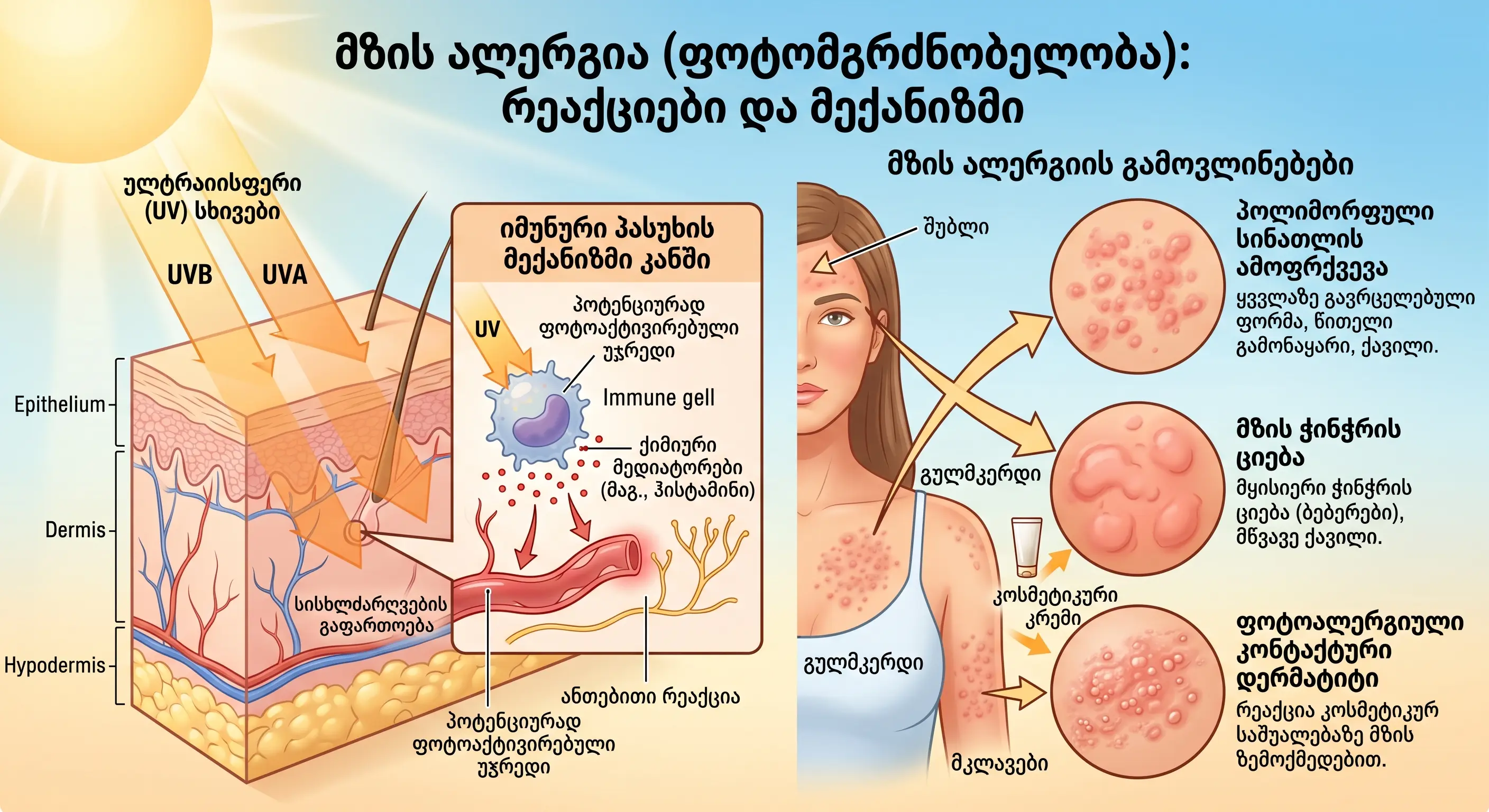 mzis-alergia-fotomgrdznobeloba-reaqciebi-da-meqanizmebi-ru