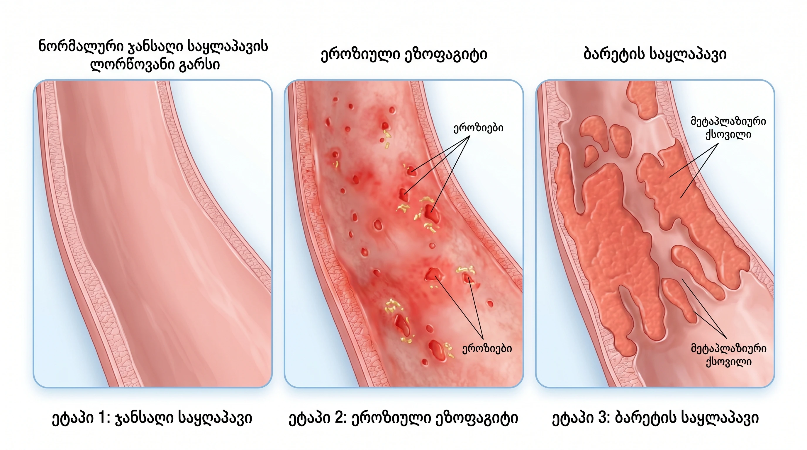 திரியிவிவி-tiaqaris-simptomebi
