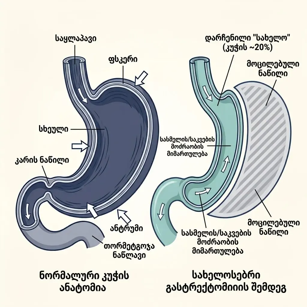 sliv-gastreqtomia-rogor-ketdeba