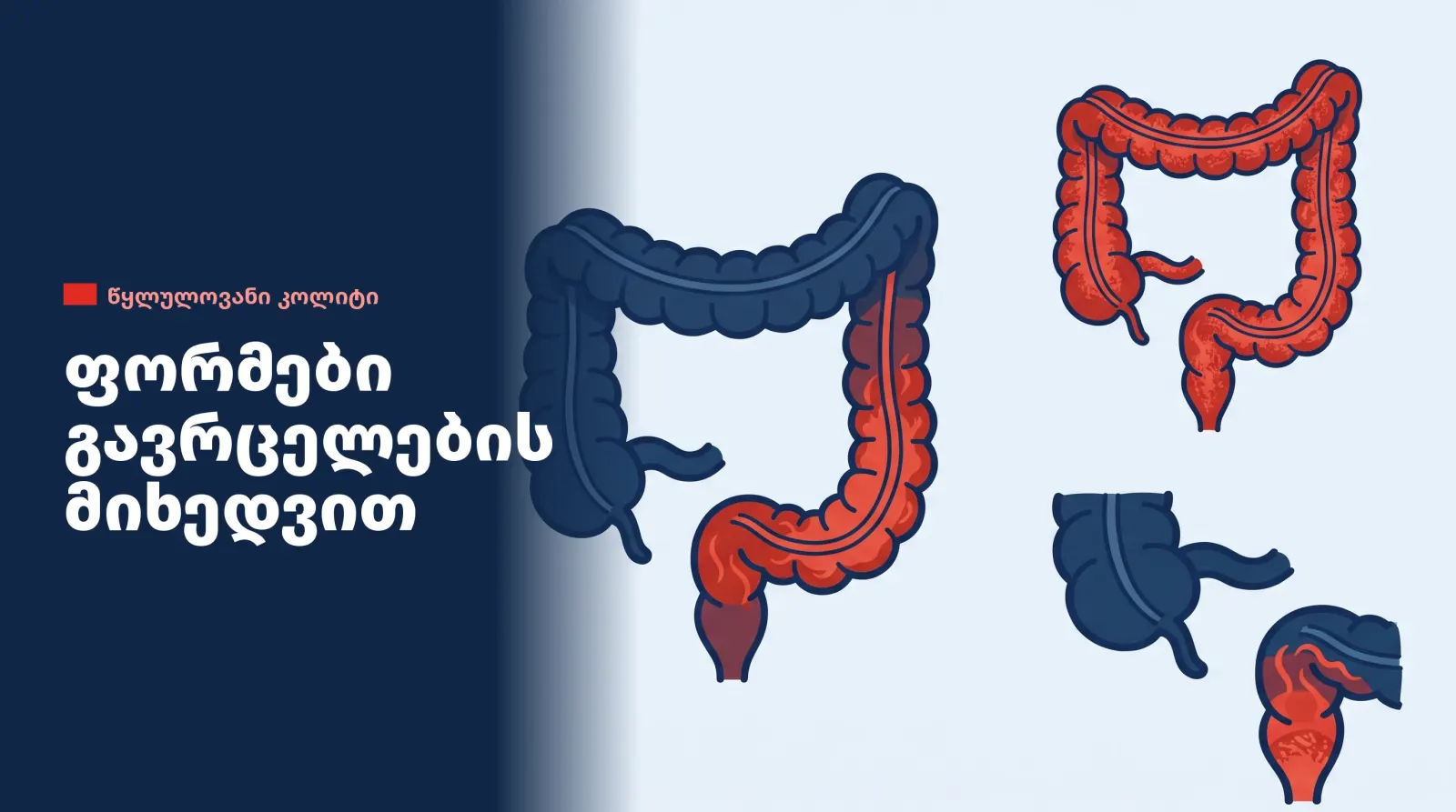 tsklulovani-colitis-fromebi