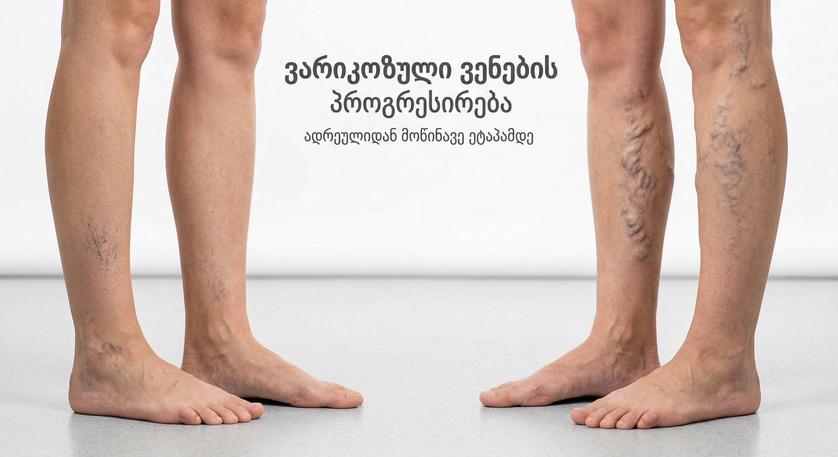 varikozuli-venebis-progresireba