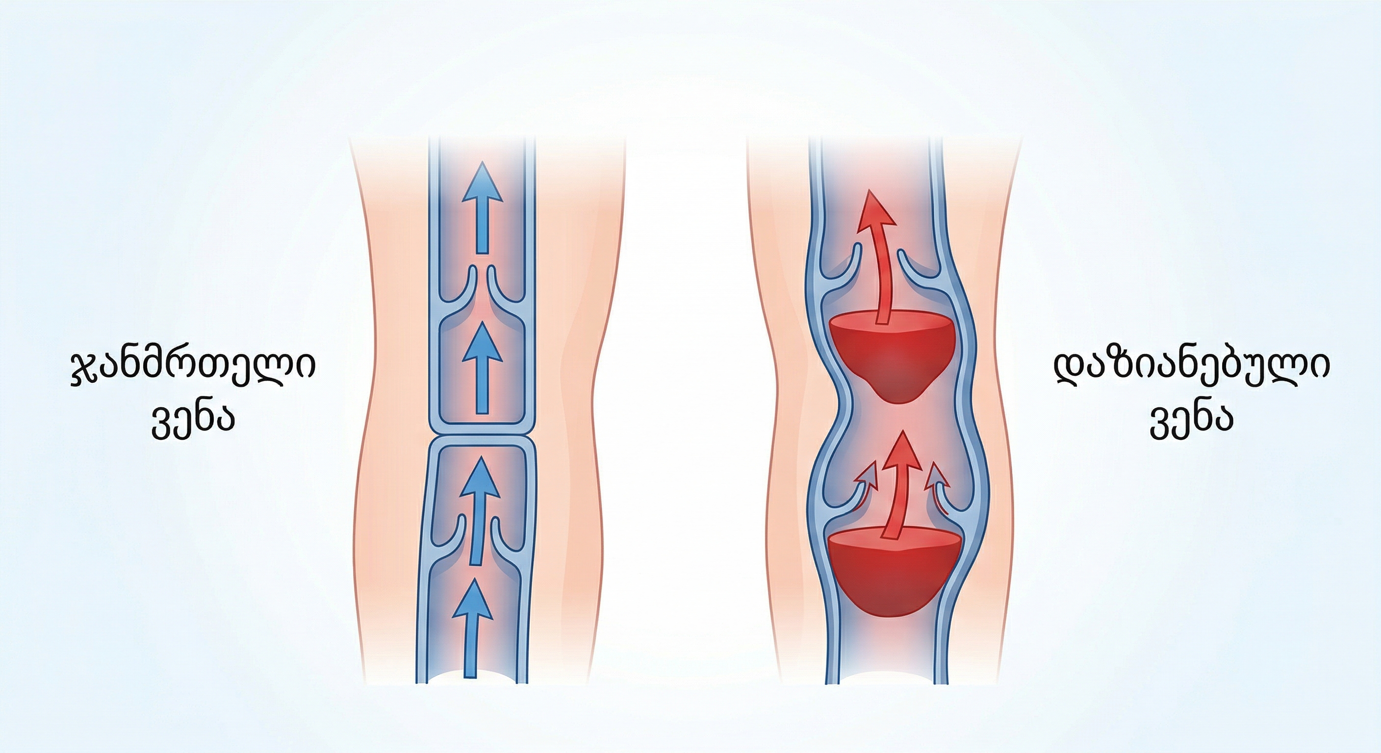 venuri-problemebi-doplerografia-varikozi