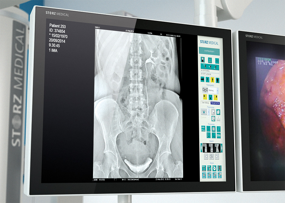 კენჭის-დაშლა-რენდგენი